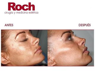 Antes y después Radiofrecuencia facial - Clínica Roch