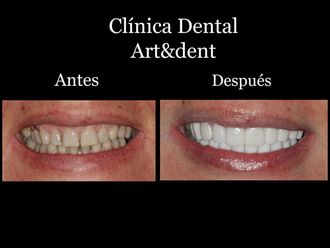 Blanqueamiento dental - 621987