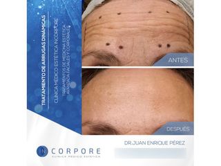 Bótox - Dr. Juan Enrique Pérez Enríquez