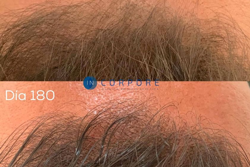 Tratamiento capilar antes y después - 820701