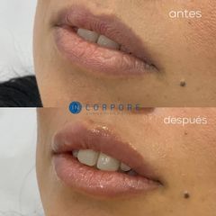 Aumento de labios - Dr. Juan Enrique Pérez Enríquez