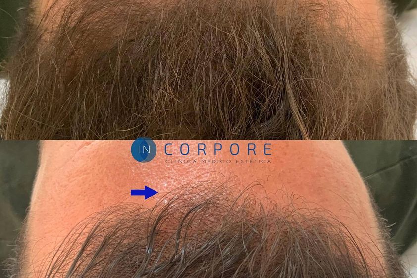 Tratamiento capilar antes y después - 820704
