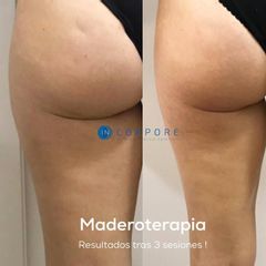 Maderoterapia - Dr. Juan Enrique Pérez Enríquez