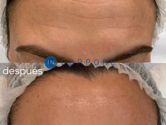 Rellenos faciales antes y después - 855263