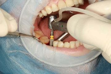 implantes dentales Clínica Cabeceran