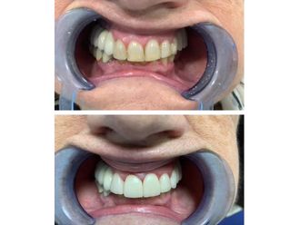 Carillas dentales - 835434
