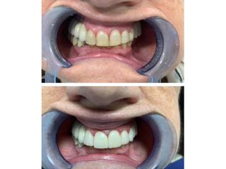 Carillas dentales - Clínica Cabeceran