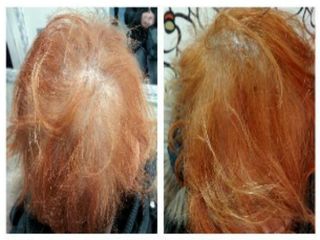 Antes y después alopecia