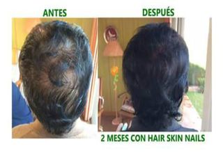 Antes y después alopecia