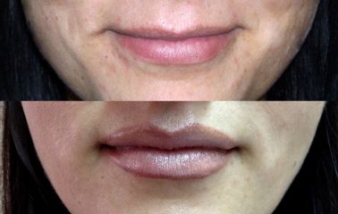 Antes y después aumento de Labios