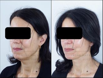 Lifting antes y después - 878358