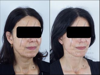 Lifting antes y después - 878359