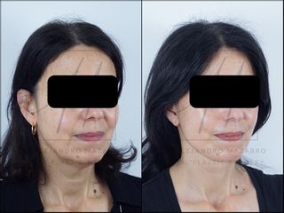 Deep Plane Facelift - 58 años