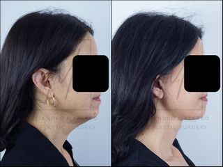 Deep Plane Facelift - 58 años