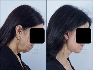 Deep Plane Facelift - 58 años