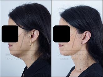 Lifting antes y después - 878362