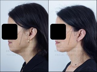 Deep Plane Facelift - 58 años