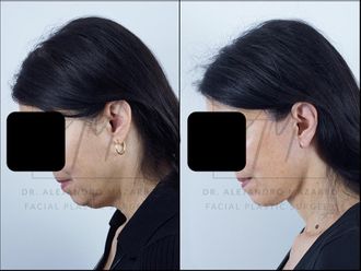 Lifting antes y después - 878363