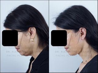 Deep Plane Facelift - 58 años