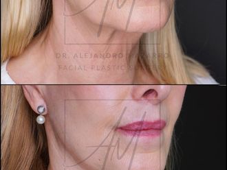 Lifting antes y después - 878364