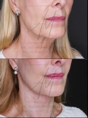 Deep Plane Facelift - 67 años