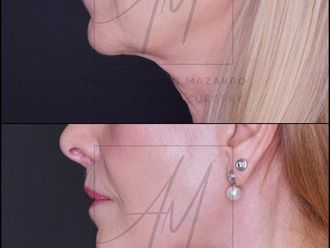 Lifting antes y después - 878365