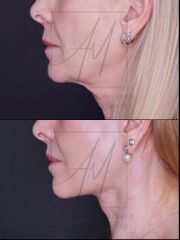 Deep Plane Facelift - 67 años