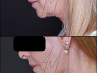 Lifting antes y después - 878366