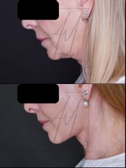 Deep Plane Facelift - 67 años