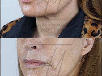 Lifting antes y después - 878367