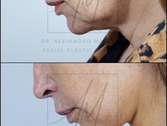 Lifting antes y después - 878368