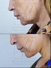 Deep Plane Facelift - 53 años