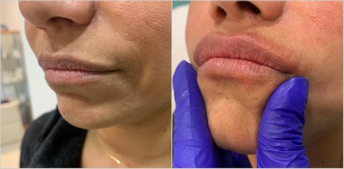 Aumento de labios - Dr. Javier Meléndez
