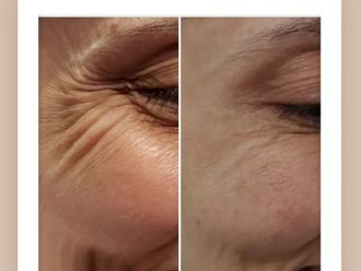 Eliminación arrugas antes y después - 876625