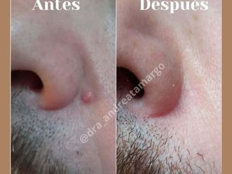 Verrugas antes y después - 876626