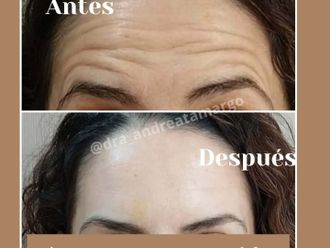 Eliminación arrugas antes y después - 876629