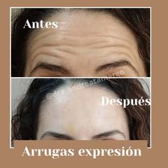 Dra. Andrea Tamargo - Eliminación de arrugas