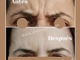 Eliminación arrugas antes y después - 876630