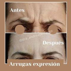 Dra. Andrea Tamargo - Eliminación de arrugas