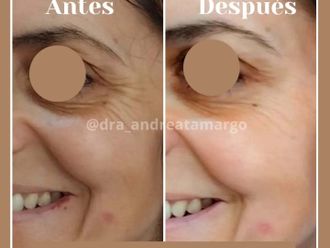 Eliminación arrugas antes y después - 876631