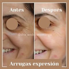 Dra. Andrea Tamargo - Eliminación de arrugas