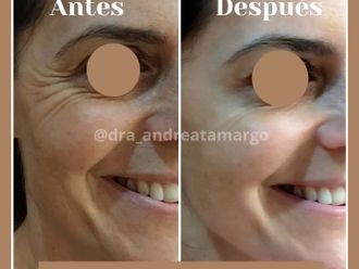 Eliminación arrugas antes y después - 876632