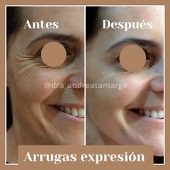 Dra. Andrea Tamargo - Eliminación de arrugas