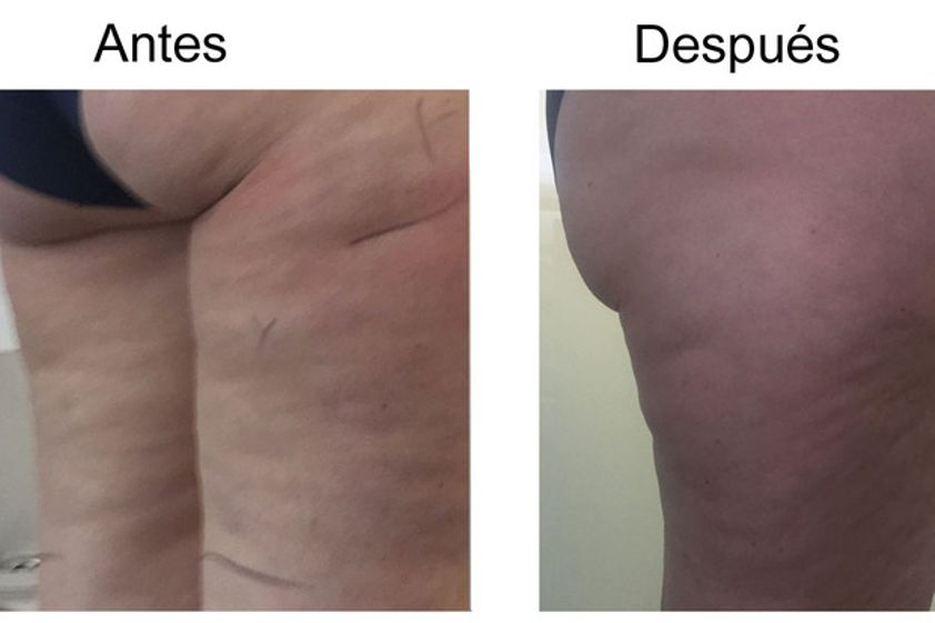 HIFU antes y después - 583617
