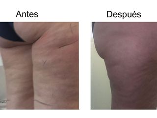 Antes y después ondas de choque