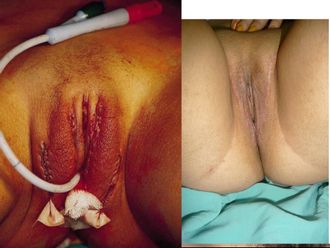 Vaginoplastia antes y después - 818405