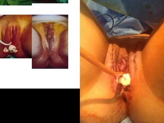 Vaginoplastia antes y después - 818427