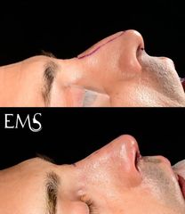 Rinoplastia - Dr. Eduardo Morera Serna