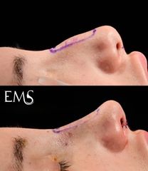 Rinoplastia - Dr. Eduardo Morera Serna