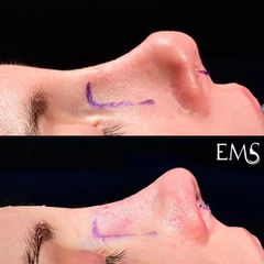 Rinoplastia - Dr. Eduardo Morera Serna